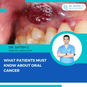 Oral Cancer Treatment in Bangalore