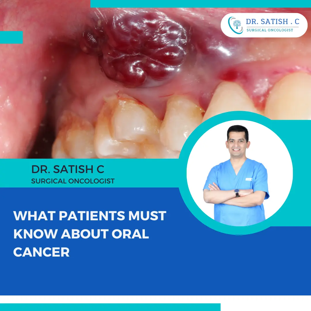 Oral Cancer Treatment in Bangalore